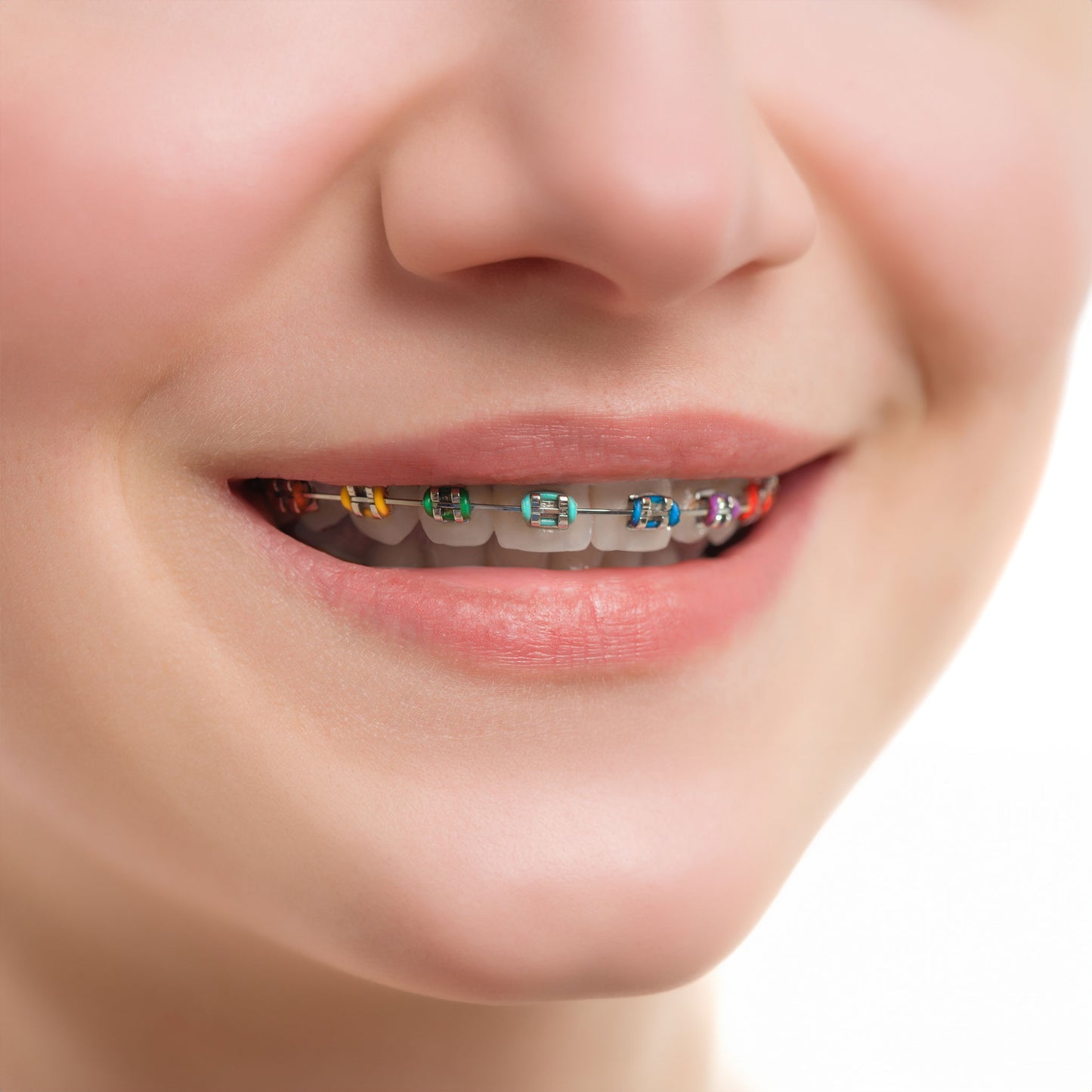 Smiling-Teen-With-Trendy-Orthodontic-Elastics