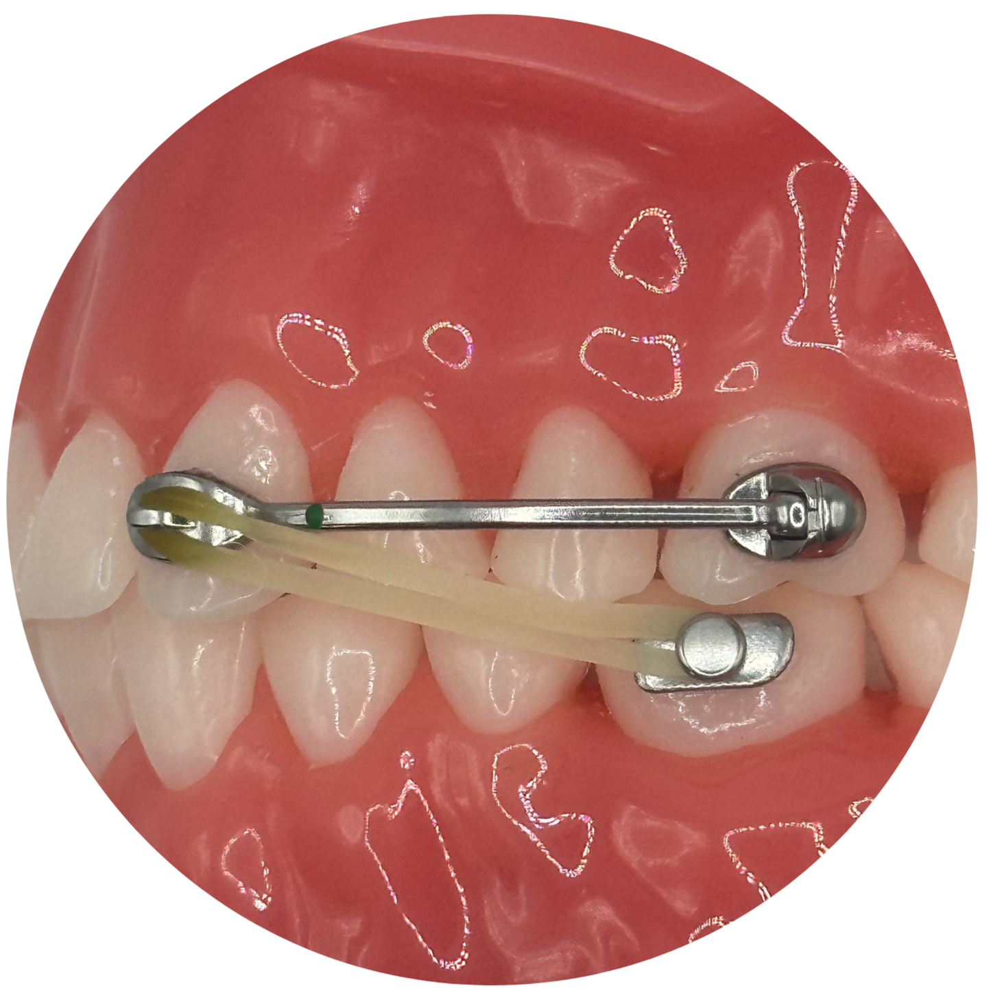 DMD Class ll Appliance