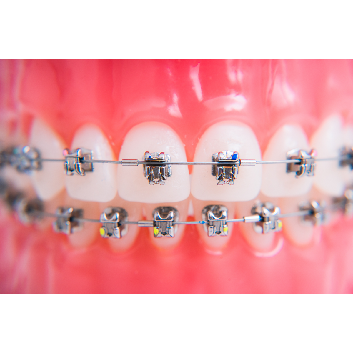 Cu Niti Archwire: 5 Advantages for Modern Orthodontics Cu Niti Archwire: 5 Advantages for Modern Orthodontics